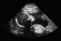 The photo shows an ultrasound image of a fetus of about 20 weeks’ gestational age.