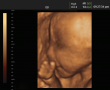 The photo shows an ultrasound image of a fetus. The rough outline of a head and body can be seen. ...