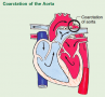 coarctation of the aorta