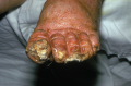 A patient with necrotizing fasciitis to the feet, caused by group A beta-hemolytic strep.