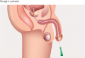 Types of catheters: Straight urinary catheter, female and male insertion.