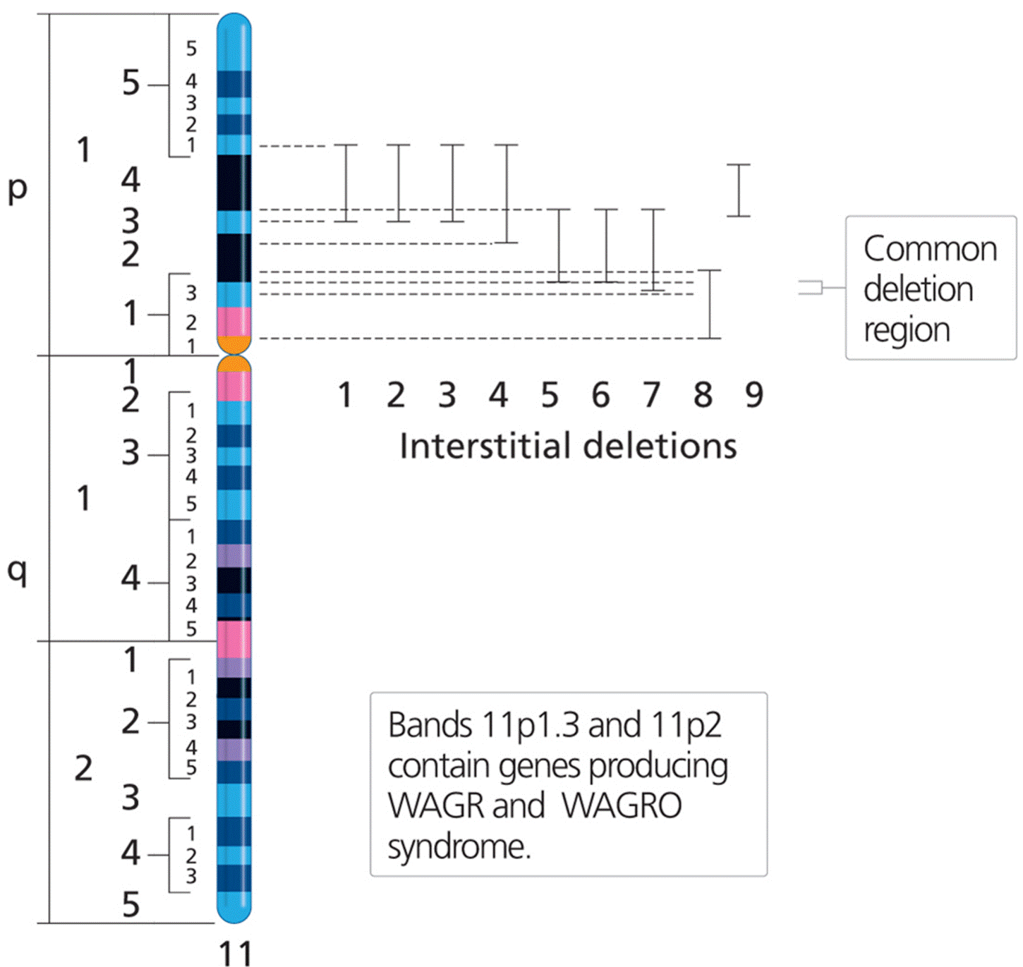 Interstitial deletions of chromosome 11 in WAGR and WAGRO syndromes