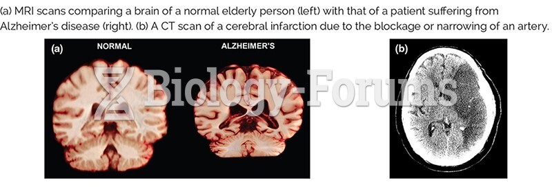MRI scans of normal elderly person compared to one with Alzheimer's 