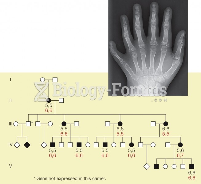 A Pedigree for Polydactyly