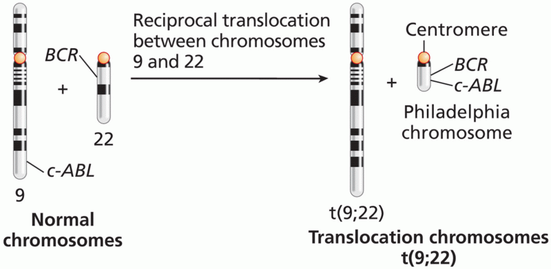 Reciprocal translocation in chronic myelogenous leukemia