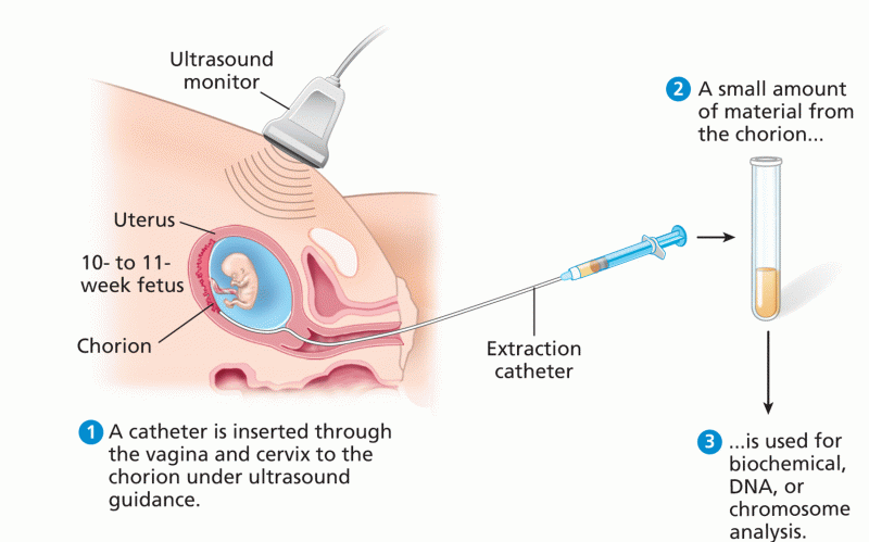 Chorionic villus sampling (CVS)