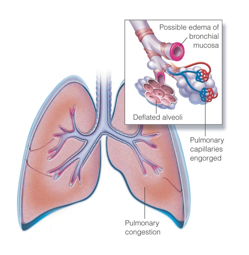 Congestive heart failure