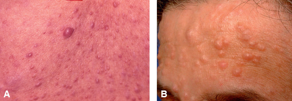 Cutaneous lesions of neurofibromatosis. A. Café-au-lait spots. B. Neurofibromas.