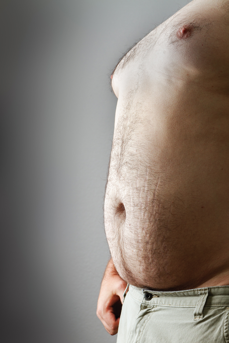 Obese individual with stretch marks (striae)