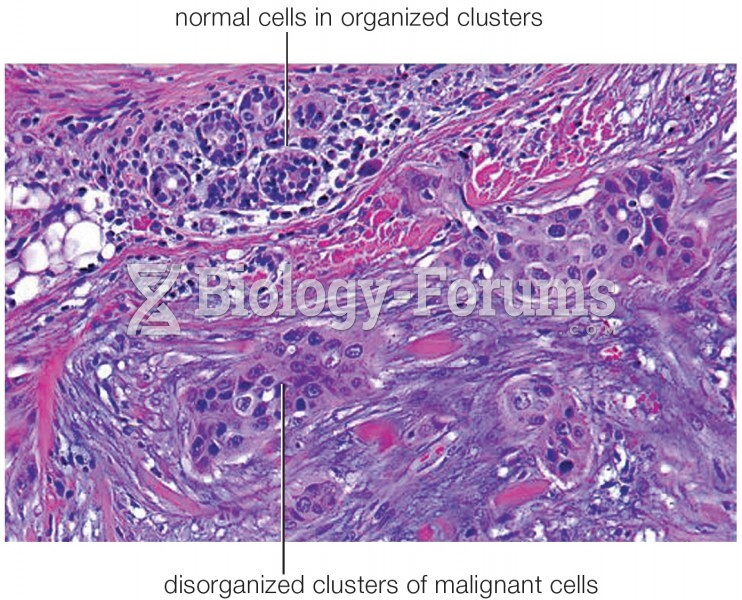 A case of breast cancer