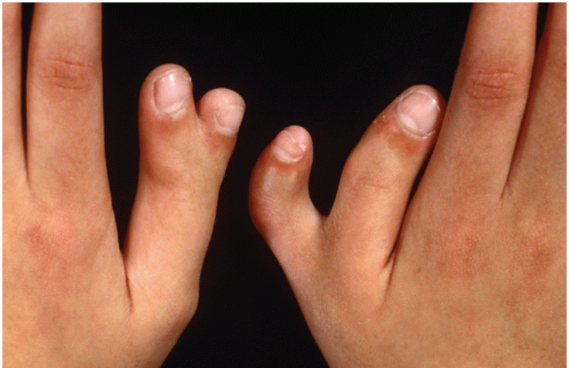 Polydactyly is an autosomal dominant trait with incomplete penetrance