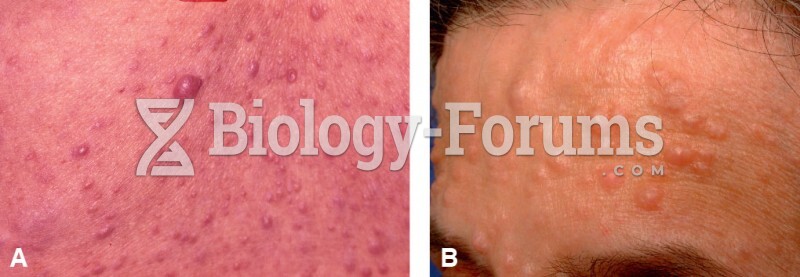 Cutaneous lesions of neurofibromatosis. A. Café-au-lait spots. B. Neurofibromas.